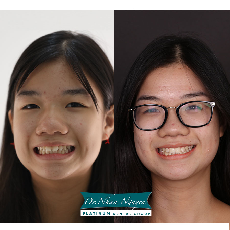 Hình ảnh Khách Hàng trước và sau khi niềng răng tại Platinum Dental