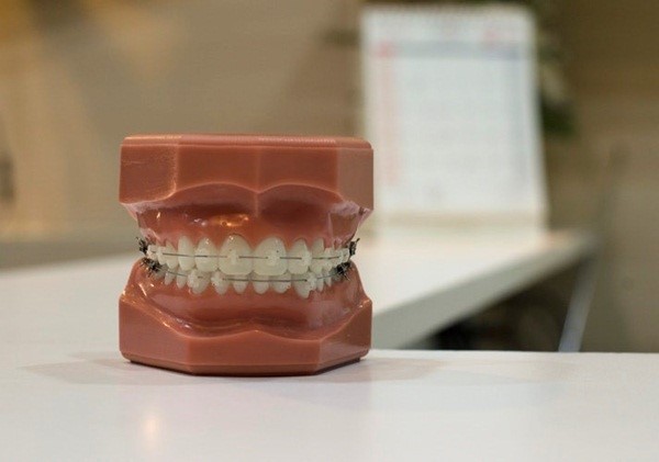 Chi phí niềng răng mắc cài sứ năm 2023 - Nha khoa Platinum