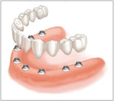 Cần thay thế phục hồi nhiều răng bị mất.