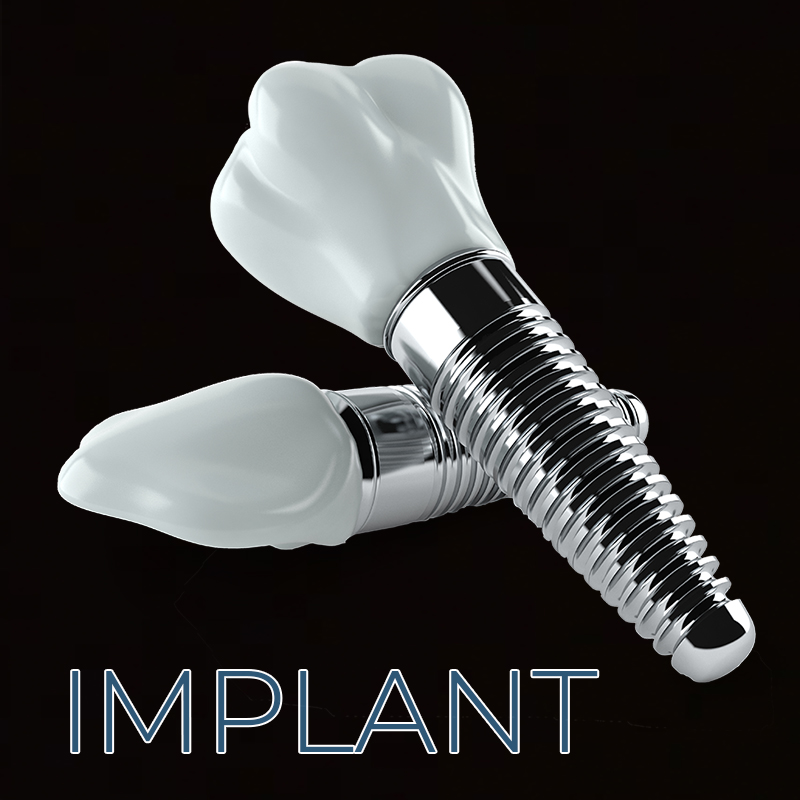 Implant-Home-Platinum-1