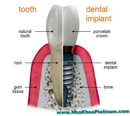Implant là chân răng nhân tạo bằng titan hoạc sứ