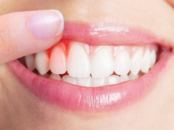 Vì sao khách hàng không nên bọc răng sứ giá rẻ?