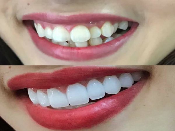 Các trường hợp răng miệng nào phù hợp phương pháp bọc răng sứ ?