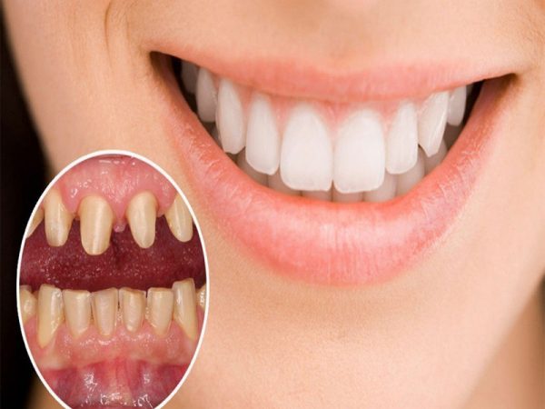 Các trường hợp răng miệng nào phù hợp phương pháp bọc răng sứ ?