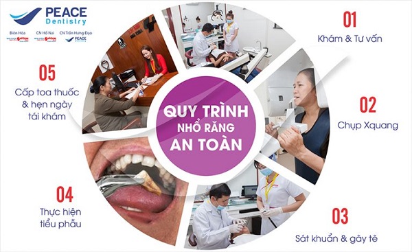 Quy trình nhổ răng tại Peace Dentistry