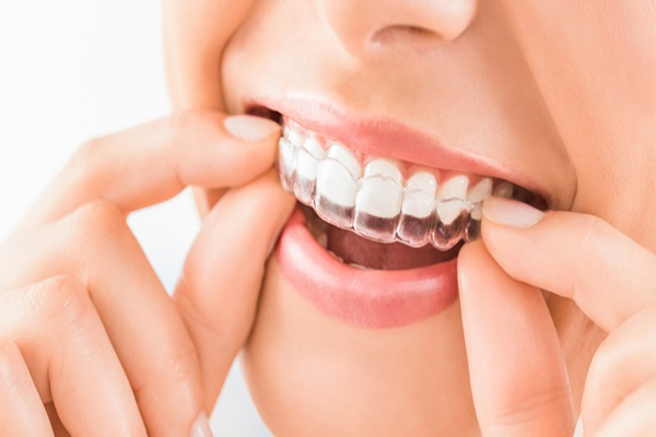 Tổng hợp các phương pháp niềng răng hô phổ biến hiện nay