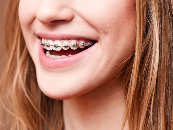 Niềng răng hô trường hợp nào cần phải nhổ răng?