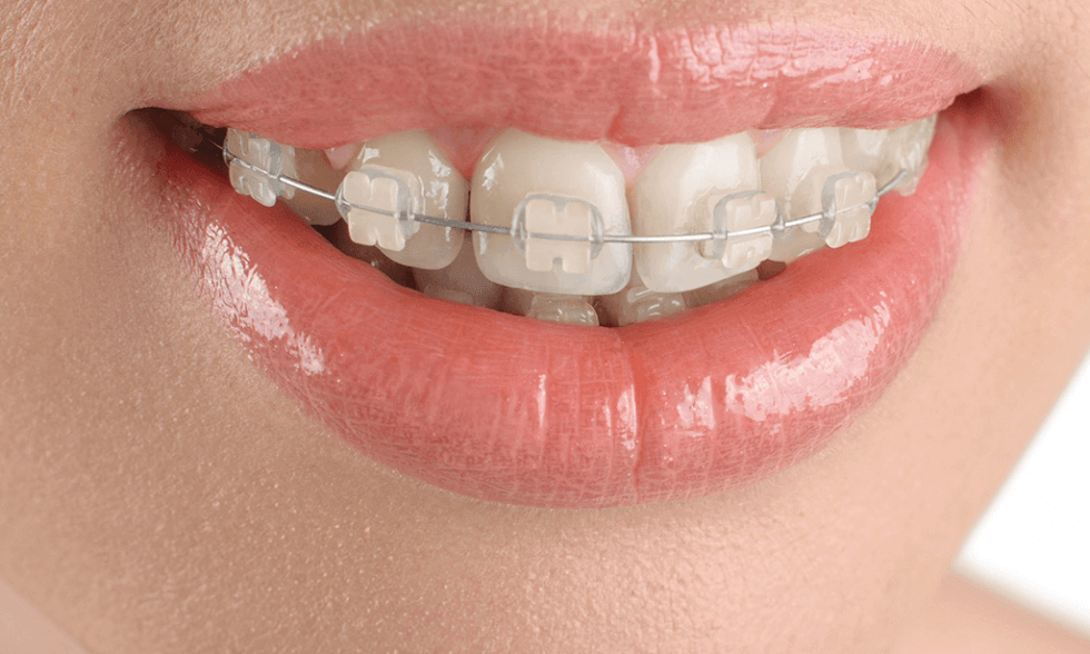 Tổng quan về phương pháp niềng răng mắc cài sứ 