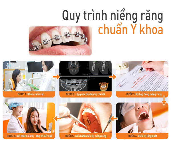 Top 7 cơ sở niềng răng thẩm mỹ uy tín và an toàn tại TPHCM