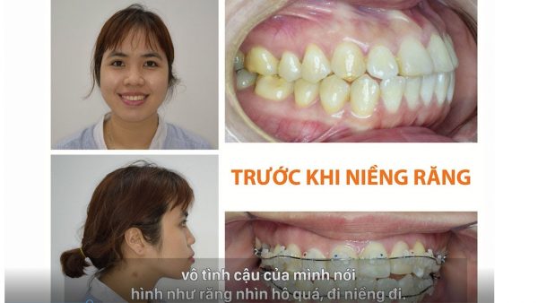Niềng răng thẩm mỹ tại TPHCM ở nha khoa Quốc tế New Gate
