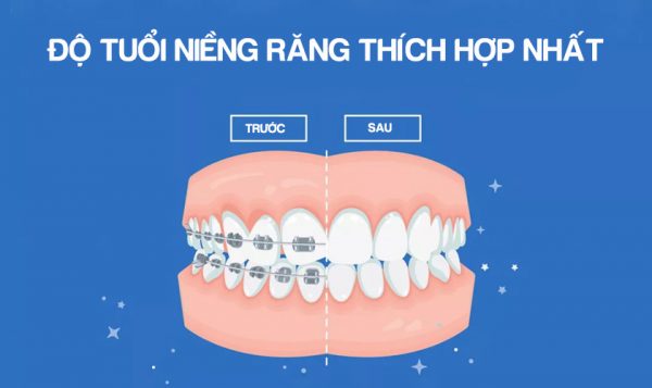 Top 7 cơ sở niềng răng thẩm mỹ uy tín và an toàn tại TPHCM