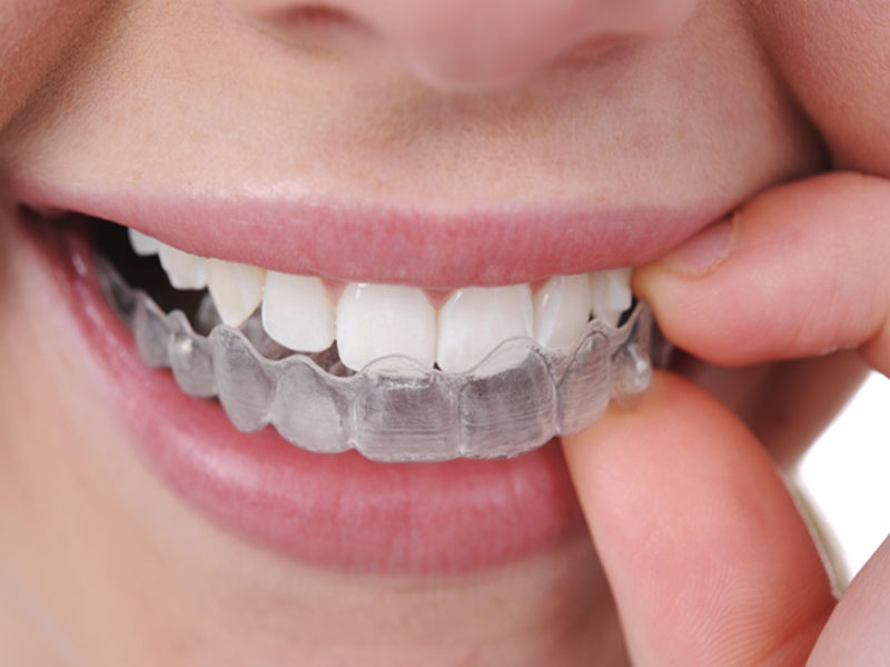 Niềng răng trong suốt - Các câu hỏi thường gặp là gì ?