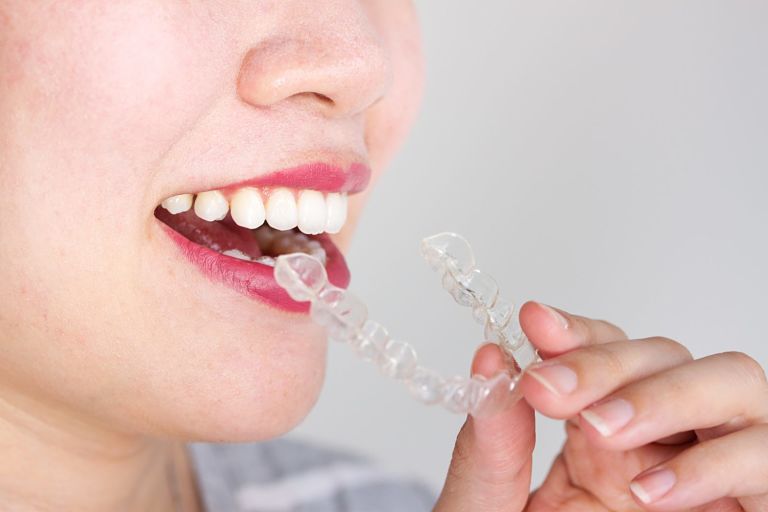 Có nhiều yếu tố ảnh hưởng đến chi phí niềng răng trong suốt