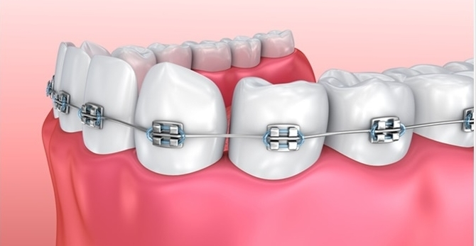 Việc niềng răng có ảnh hưởng đến sức khỏe không?