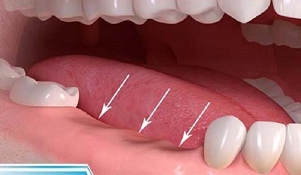 Trồng răng hàm khắc phục tình trạng gì?