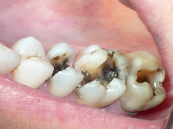Răng sâu cần nhổ sớm để tránh ảnh hưởng đến chân răng và tủy răng