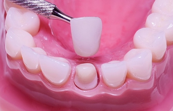 Quy trình trồng răng khểnh bạn nên biết.