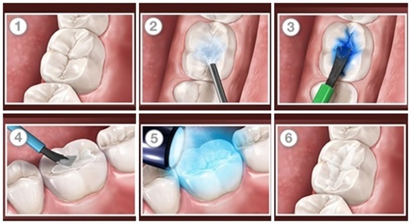 Cần lưu ý gì để tránh cho việc bạn phải đặt câu hỏi về hàn răng có đau không