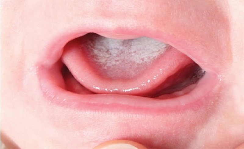 Tưa lưỡi ở trẻ em – căn bệnh cực kỳ  nguy hiểm