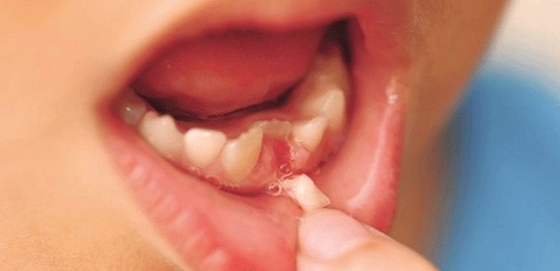 Bệnh viêm tủy răng