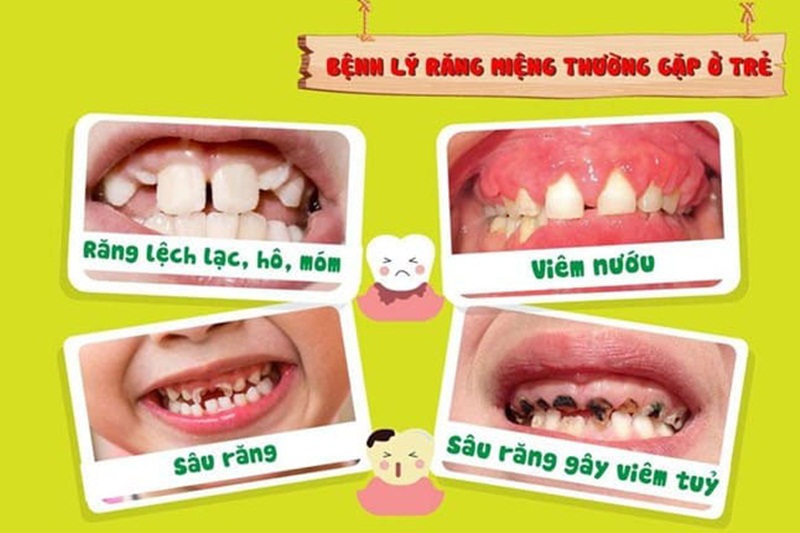 Các bệnh về răng miệng ở trẻ em