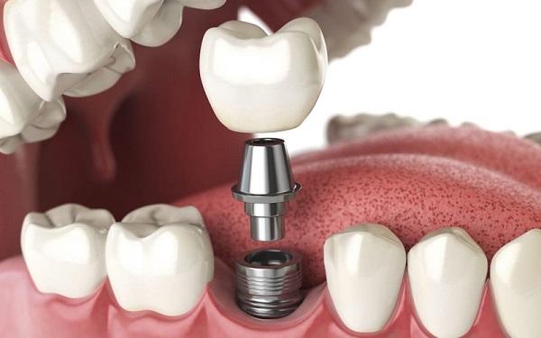 Phương pháp trồng răng implant có tỉ lệ thành công trên 90%.