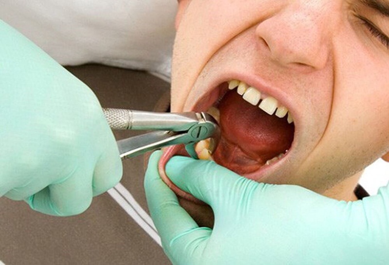 Quy trình xử lý răng khôn mọc lệch gồm mấy bước?