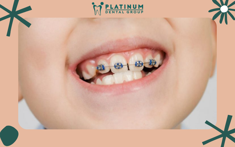 Kết quả niềng răng tại Nha khoa Platinum