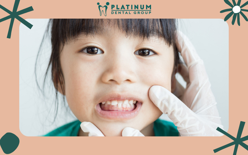 Niềng răng cho trẻ vào độ tuổi nào là thích hợp?