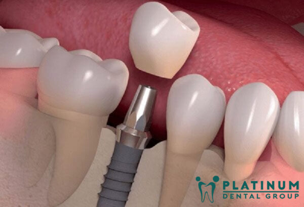 Quy trình trồng răng implant