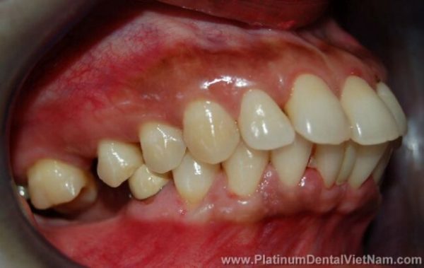 Hiện tượng hô răng cả hai hàm là tình trạng lệch lạc răng hàm mặt