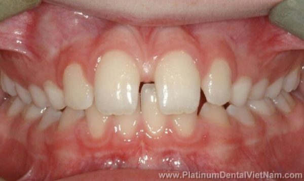 Nếu trong cung hàm có răng bị mất, thiếu hay các răng đầy đủ