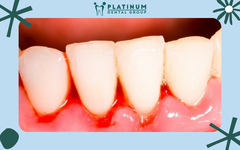 Không nên  chải răng quá mạnh vì có thể gây nên nhiều ảnh hưởng khiến răng lợi chảy máu và nhiều tổn thương nghiêm trọng khác.