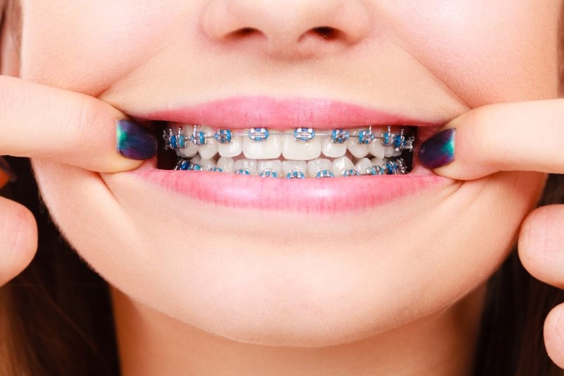 Có nên niềng răng không? | nhakhoaplatinum.com