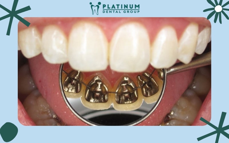 Niềng răng mắc cài sẽ nằm bên trong răng nên sẽ nâng cao tính thẩm mỹ trong quá trình niềng.