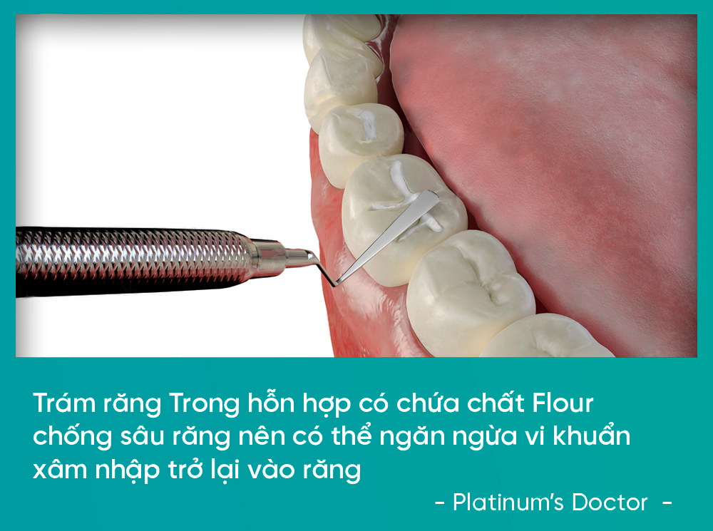 Trám răng trong hỗn hợp có chứa chất Flour chống sâu răng nên có thể ngăn ngừa vi khuẩn xâm nhập trở lại vào răng - Platinum’s Doctor