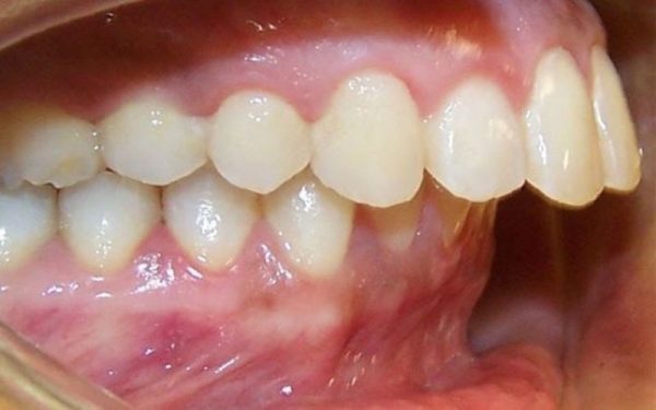 Răng hô nặng sẽ khiến những chiếc răng chìa hẳn ra ngoài, kém duyên và làm bệnh nhân cực kì mất tự tin