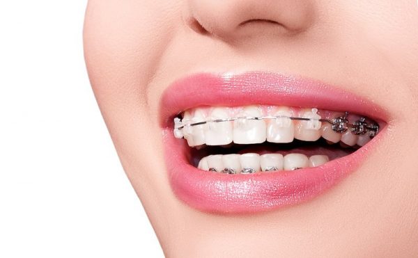 Niềng răng là phương pháp hiệu quá đỉnh cao trong nha khoa mà bạn cần tham khảo qua
