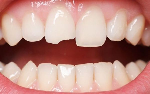 Răng bị mẻ vỡ đến từ rất nhiều nguyên nhân, răng bị mẻ gây nên sự mất tự tin trong giao tiếp hàng ngày.