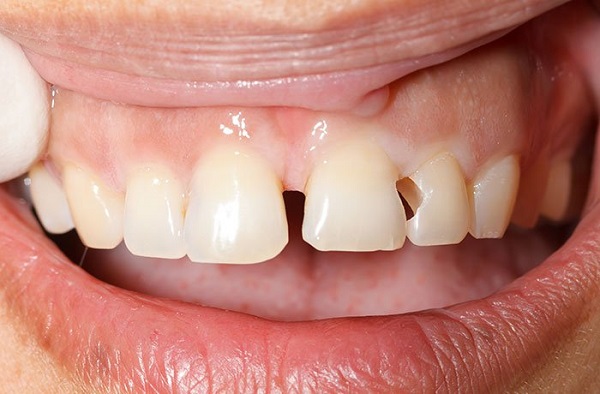 Sâu răng là tình trạng mà nhiều người mắc phải, trám răng cửa cũng có thể khắc phục vấn đề sâu răng nhanh chóng.