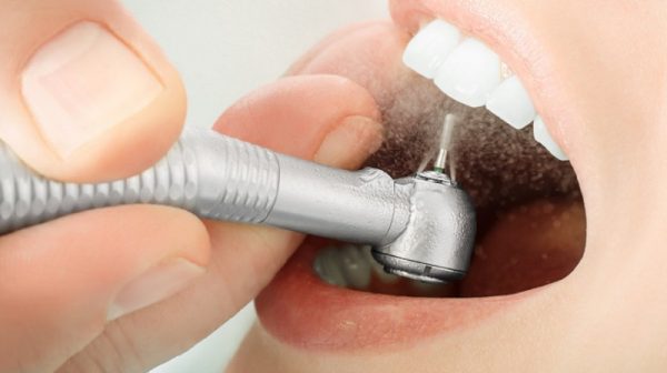 Kỹ thuật trám răng hiện nay vô cùng hiện đại và tiên tiến với những vật liệu vô cùng bền chắc và đồng màu với răng thật.
