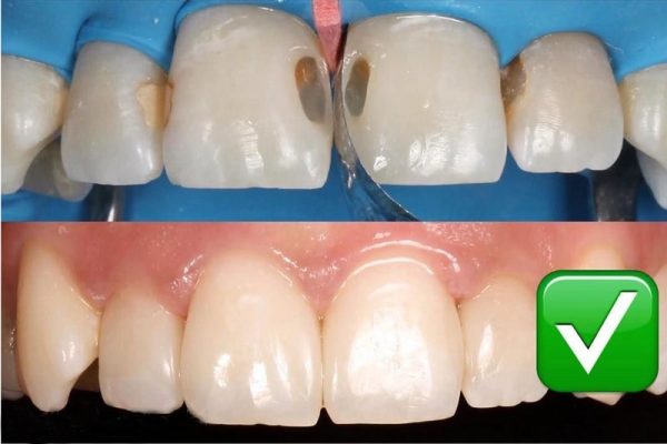 Quá trình trám răng được thực hiện tỉ mỉ giúp bạn có thể cải thiện được khuyết điểm một cách triệt để nhất.