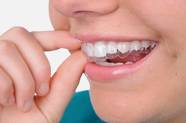 Niềng răng Invisalign thích hợp với mọi độ tuổi, tuy nhiên vào khoảng độ tuổi từ 16 đến 18 tuổi sẽ đem lại hiệu quả cao hơn. 