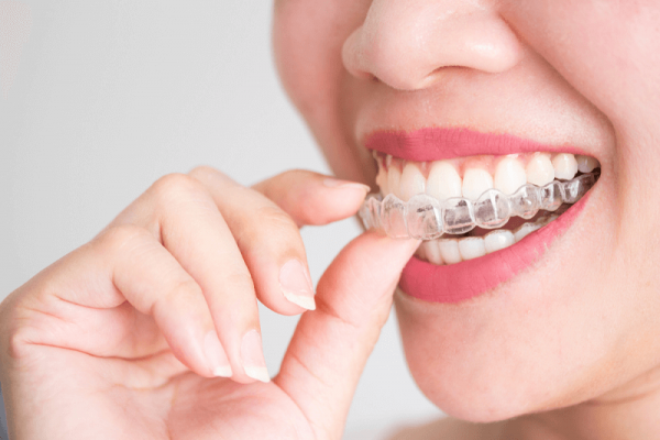 Niềng răng Invisalign đem lại rất nhiều lợi ích nên được nhiều khách hàng ưa chuộng.