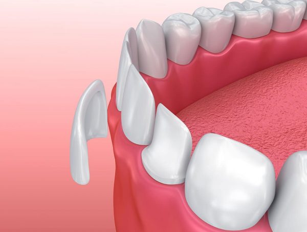Dán răng sứ có nhiều ưu điểm nổi bật