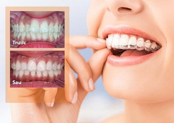Niềng răng Invisalign đem lại hiệu quả lớn trong việc điều trị và khắc phục những khuyết điểm răng hàm. 