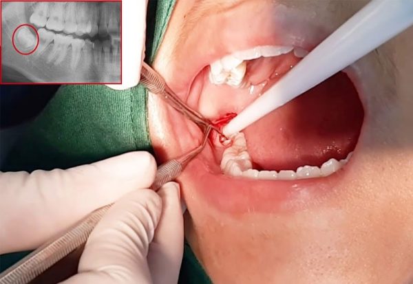 Với tình trạng răng khôn bị sâu vỡ, tùy tình trạng và giai đoạn sâu răng mà Nha sĩ sẽ lên pháp đồ điều trị sao cho phù hợp nhất.