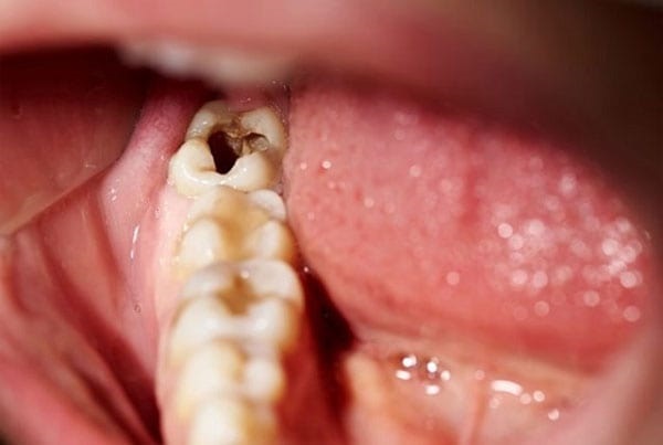 Răng khôn số 8 nằm ở vị trí khó vệ sinh vì vậy dễ dàng tồn đọng thức ăn thừa và mảng bám gây ra sâu răng.