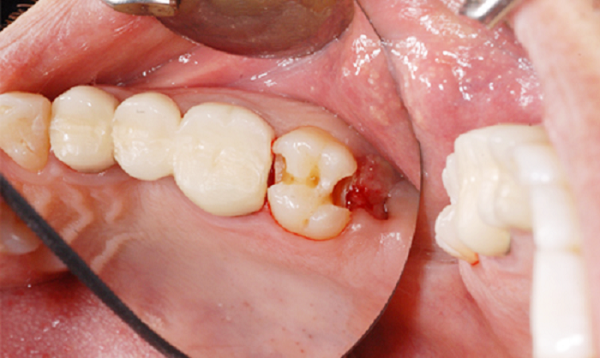 Sâu răng số 8 gây ra  nhiều cảm giác ê buốt ảnh hưởng đến sức nhai và tính thẩm mỹ của răng hàm.
