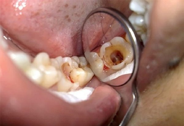Nếu không có biện pháp xử lý sớm, sâu răng số 8 có thể gây vỡ răng, dẫn đến nhiều  bệnh lý răng miệng nguy hiểm khác.
